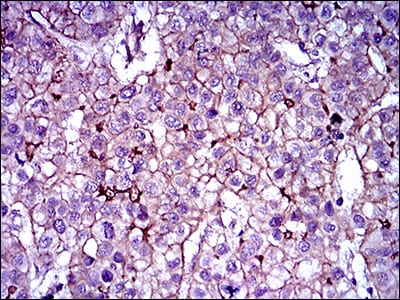 Figure 5: Immunohistochemical analysis of paraffin-embedded liver cancer tissues using ABCB5 mouse mAb with DAB staining.