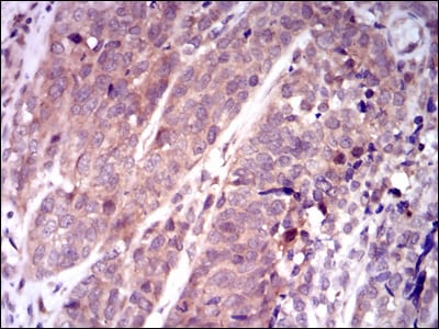 Figure 3: Immunohistochemical analysis of paraffin-embedded bladder cancer tissues using KEAP1 mouse mAb with DAB staining.