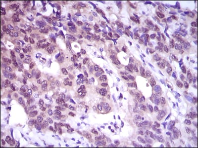 Figure 5: Immunohistochemical analysis of paraffin-embedded esophageal cancer tissues using ACLY mouse mAb with DAB staining.