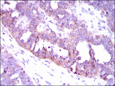 Figure 6: Immunohistochemical analysis of paraffin-embedded ovarian cancer tissues using CAMK4 mouse mAb with DAB staining.