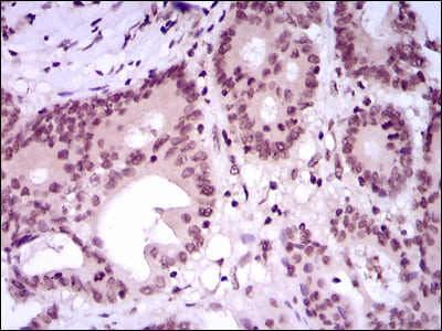 Figure 5: Immunohistochemical analysis of paraffin-embedded colon cancer tissues using MEF2C mouse mAb with DAB staining.