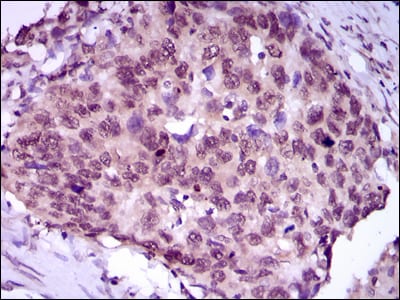 Figure 6: Immunohistochemical analysis of paraffin-embedded esophageal cancer tissues using MEF2C mouse mAb with DAB staining.