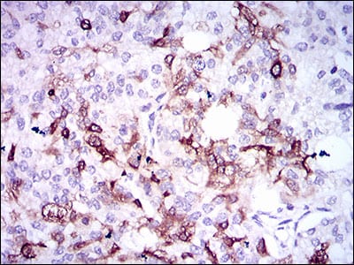 Figure 3: Immunohistochemical analysis of paraffin-embedded prostate cancer tissues using SPP1 mouse mAb with DAB staining.