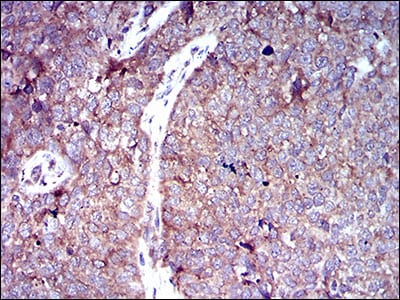 Figure 7: Immunohistochemical analysis of paraffin-embedded bladder cancer tissues using SLC2A4 mouse mAb with DAB staining.