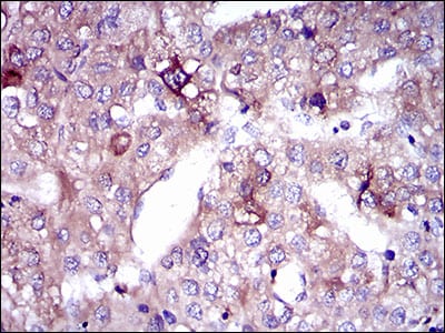 Figure 5: Immunohistochemical analysis of paraffin-embedded liver cancer tissues using SLC27A5 mouse mAb with DAB staining.