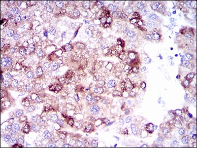 Figure 4: Immunohistochemical analysis of paraffin-embedded liver cancer tissues using SLC27A5 mouse mAb with DAB staining.