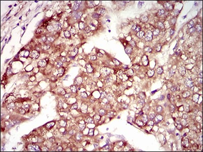 Figure 4: Immunohistochemical analysis of paraffin-embedded liver cancer tissues using MAP1LC3A mouse mAb with DAB staining.