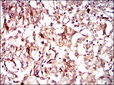 Figure 6: Immunohistochemical analysis of paraffin-embedded renal cancer tissues using GUCY1A3 mouse mAb with DAB staining.