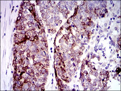 Figure 5: Immunohistochemical analysis of paraffin-embedded esophageal cancer tissues using CK5 mouse mAb with DAB staining.