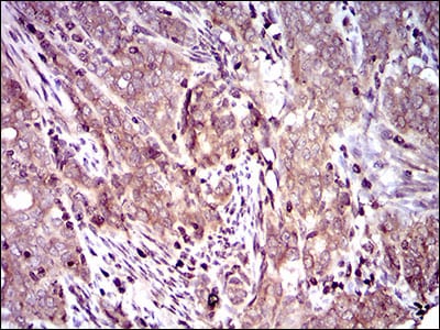 Figure 6: Immunohistochemical analysis of paraffin-embedded cervical cancer tissues using DCTN4 mouse mAb with DAB staining.