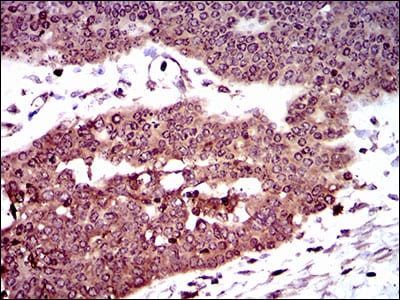 Figure 7: Immunohistochemical analysis of paraffin-embedded ovarian cancer tissues using DCTN4 mouse mAb with DAB staining.