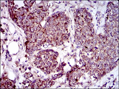 Figure 5: Immunohistochemical analysis of paraffin-embedded breast cancer tissues using MRPL42 mouse mAb with DAB staining.