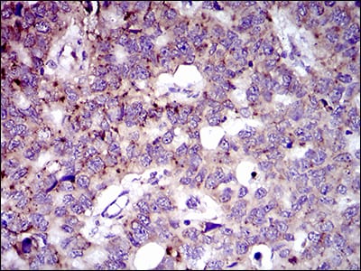 Figure 6: Immunohistochemical analysis of paraffin-embedded esophageal cancer tissues using MRPL42 mouse mAb with DAB staining.