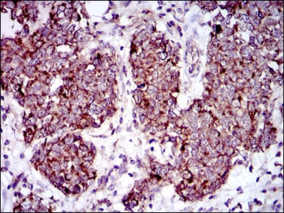 Figure 5: Immunohistochemical analysis of paraffin-embedded breast cancer tissues using MRPL42 mouse mAb with DAB staining.