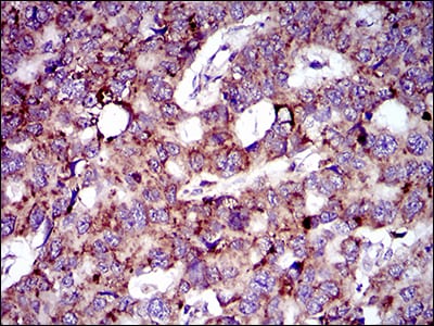 Figure 6: Immunohistochemical analysis of paraffin-embedded esophageal cancer tissues using MRPL42 mouse mAb with DAB staining.