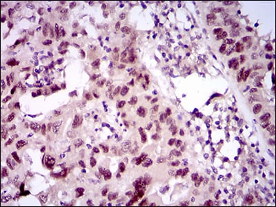 Figure 5: Immunohistochemical analysis of paraffin-embedded endometrial cancer tissues using TP53BP1 mouse mAb with DAB staining.