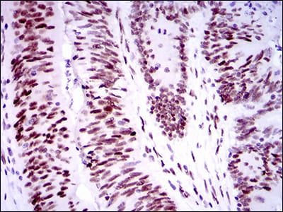 Figure 4: Immunohistochemical analysis of paraffin-embedded colon cancer tissues using TP53BP1 mouse mAb with DAB staining.