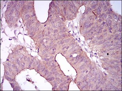 Figure 6: Immunohistochemical analysis of paraffin-embedded rectum cancer tissues using ITGA2B mouse mAb with DAB staining.