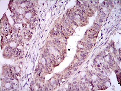 Figure 6: Immunohistochemical analysis of paraffin-embedded rectum cancer tissues using ITGA2B mouse mAb with DAB staining.