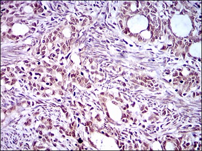 Figure 3: Immunohistochemical analysis of paraffin-embedded cervical cancer tissues using KLF1 mouse mAb with DAB staining.