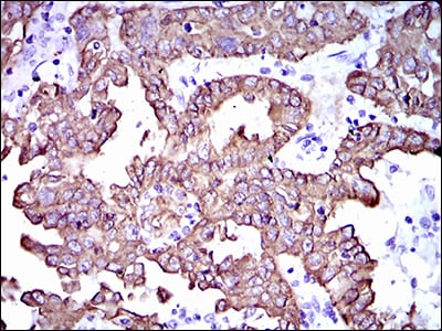 Figure 4: Immunohistochemical analysis of paraffin-embedded endometrial cancer tissues using CK5 mouse mAb with DAB staining.