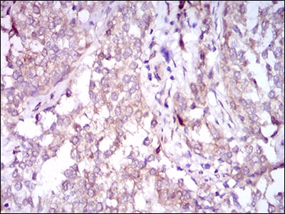 Figure 6: Immunohistochemical analysis of paraffin-embedded bladder cancer tissues using SQSTM1 mouse mAb with DAB staining.