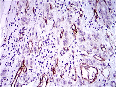 Figure 6: Immunohistochemical analysis of paraffin-embedded liver cancer tissues using GSC mouse mAb with DAB staining.