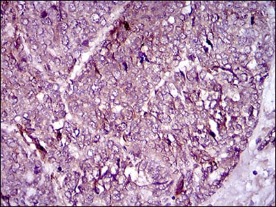 Figure 6: Immunohistochemical analysis of paraffin-embedded esophageal cancer tissues using MCAM mouse mAb with DAB staining.