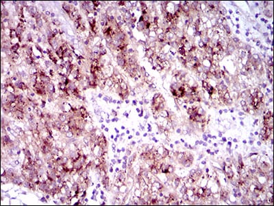 Figure 3: Immunohistochemical analysis of paraffin-embedded liver cancer tissues using FLT3 mouse mAb with DAB staining.