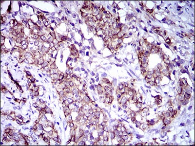 Figure 5: Immunohistochemical analysis of paraffin-embedded cervical cancer tissues using ALCAM mouse mAb with DAB staining.