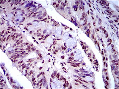 Figure 4: Immunohistochemical analysis of paraffin-embedded rectum cancer tissues using NAPSA mouse mAb with DAB staining.