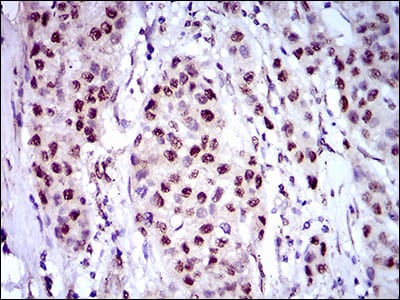 Figure 5: Immunohistochemical analysis of paraffin-embedded liver cancer tissues using NAPSA mouse mAb with DAB staining.