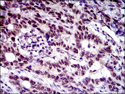 Figure 3: Immunohistochemical analysis of paraffin-embedded esophageal cancer tissues using CFLAR mouse mAb with DAB staining.