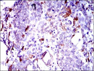 Figure 4: Immunohistochemical analysis of paraffin-embedded breast cancer tissues using GPNMB mouse mAb with DAB staining.