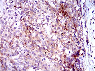 Figure 5: Immunohistochemical analysis of paraffin-embedded esophagus cancer tissues using GPNMB mouse mAb with DAB staining.