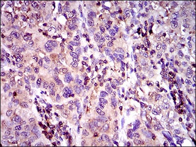 Figure 4: Immunohistochemical analysis of paraffin-embedded endometrial cancer tissues using ABCC4 mouse mAb with DAB staining.