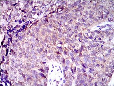 Figure 5: Immunohistochemical analysis of paraffin-embedded bladder cancer tissues using ABCC4 mouse mAb with DAB staining.