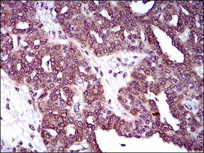 Figure 4: Immunohistochemical analysis of paraffin-embedded ovarian cancer tissues using DNM1L mouse mAb with DAB staining.