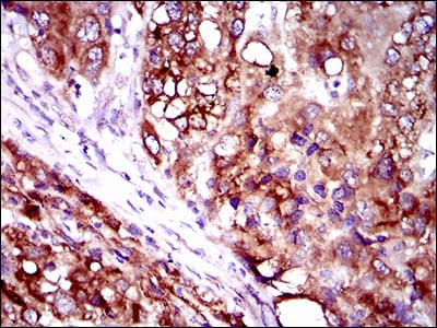 Figure 3: Immunohistochemical analysis of paraffin-embedded liver cancer tissues using SLC27A2 mouse mAb with DAB staining.