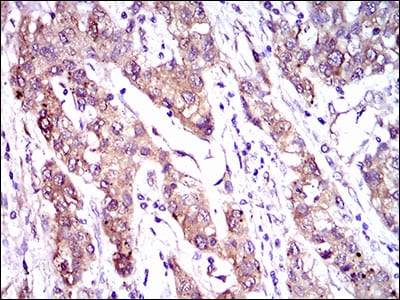 Figure 4: Immunohistochemical analysis of paraffin-embedded liver cancer tissues using ABCC4 mouse mAb with DAB staining.