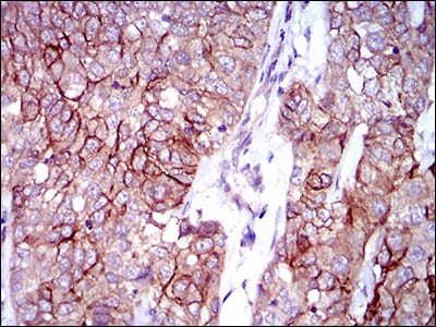 Figure 6: Immunohistochemical analysis of paraffin-embedded bladder cancer tissues using ALCAM mouse mAb with DAB staining.