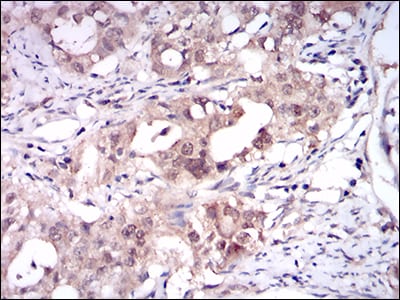 Figure 4: Immunohistochemical analysis of paraffin-embedded cervical cancer tissues using ONECUT3 mouse mAb with DAB staining.