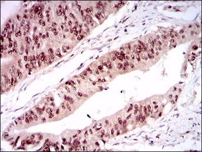 Figure 5: Immunohistochemical analysis of paraffin-embedded rectum cancer tissues using ONECUT3 mouse mAb with DAB staining.