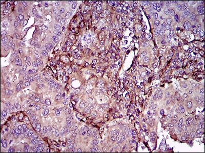 Figure 5: Immunohistochemical analysis of paraffin-embedded endometrial cancer tissues using THY1 mouse mAb with DAB staining.