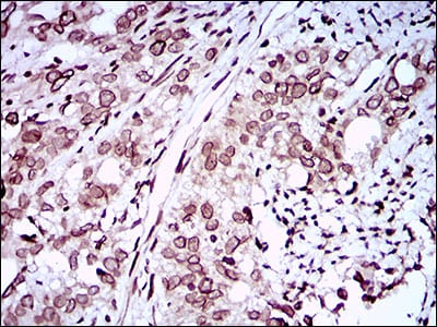 Figure 5: Immunohistochemical analysis of paraffin-embedded cervical cancer tissues using ZEB1 mouse mAb with DAB staining.