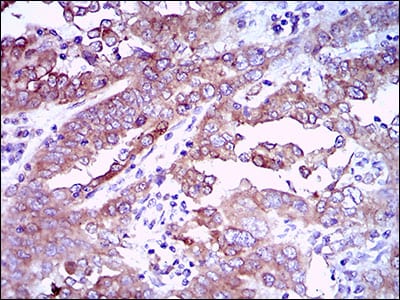 Figure 5: Immunohistochemical analysis of paraffin-embedded endometrial cancer tissues using EGFR mouse mAb with DAB staining.