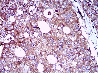 Figure 6: Immunohistochemical analysis of paraffin-embedded esophageal cancer tissues using EGFR mouse mAb with DAB staining.