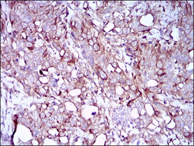 Figure 5: Immunohistochemical analysis of paraffin-embedded cervical cancer tissues using SYCP3 mouse mAb with DAB staining.