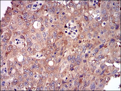 Figure 5: Immunohistochemical analysis of paraffin-embedded endometrial cancer tissues using DIS3L2 mouse mAb with DAB staining.