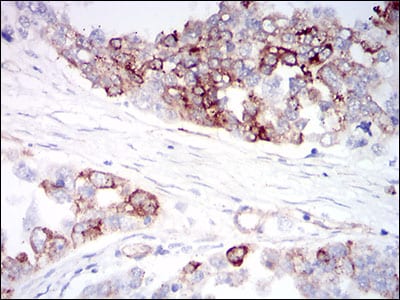 Figure 3: Immunohistochemical analysis of paraffin-embedded ovarian cancer tissues using CK5 mouse mAb with DAB staining.